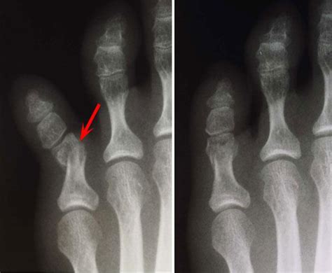 Toe and Forefoot Fractures - OrthoInfo - AAOS