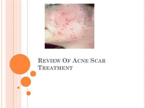 PPT - Acne Scar Treatment PowerPoint Presentation, free download - ID ...