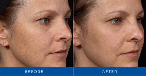 Clear + Brilliant Before & After Photos | Cosmetic Dermatology