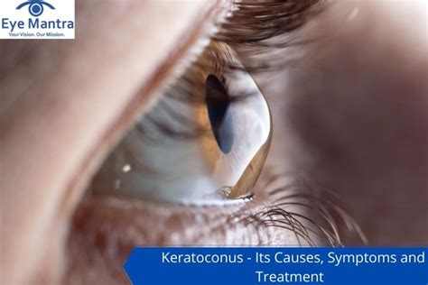 Cornea Guttata: Symptoms And Treatment | How Relate To Phaco