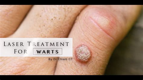 Warts removal with Laser Treatment | Dr. Chiam CT - Oasis Medical ...