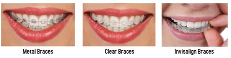 How Much Do Braces For Adults Cost? - North Durham Orthodontics