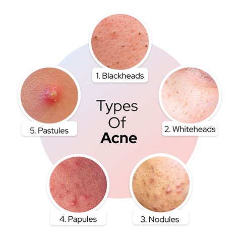 Papules And Pustules