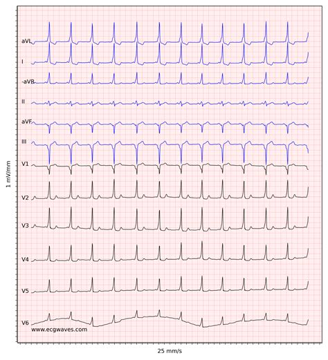 Pre-excitation, Atrioventricular Reentrant (Reentry) Tachycardia (AVRT ...