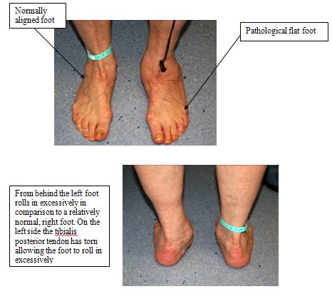 Flat Foot Surgery | The Tagoe Clinic