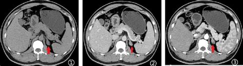 Adrenal CT enhancement findings: (1) CT scan of the adrenal gland ...