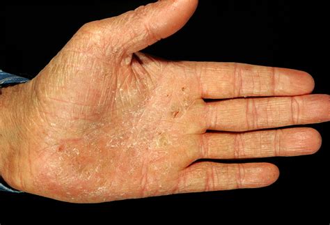 SKIN DISEASE TYPES: Vesicular Hand Dermatitis (Skin Disease type)