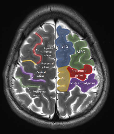 Postcentral Gyrus Mri