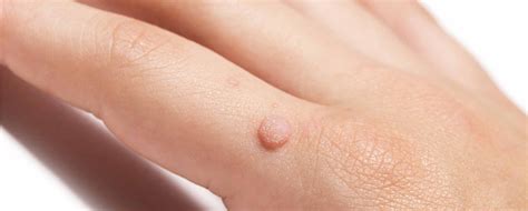 Causes Of Hand Warts