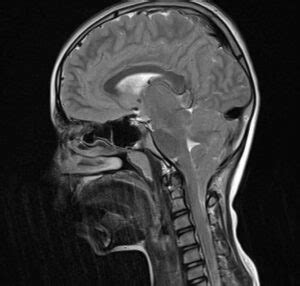 Cerebellar Tonsillar Ectopia | Neurosurgery located in Fort Worth ...