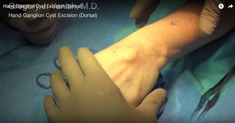 Ganglion Cyst Removal