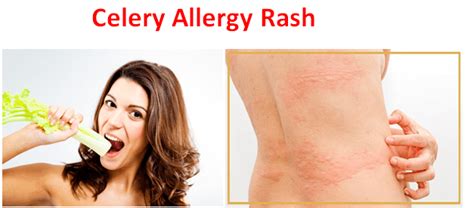 Celery Allergy Symptoms, Can you be allergic to Celery? - Fruits Facts