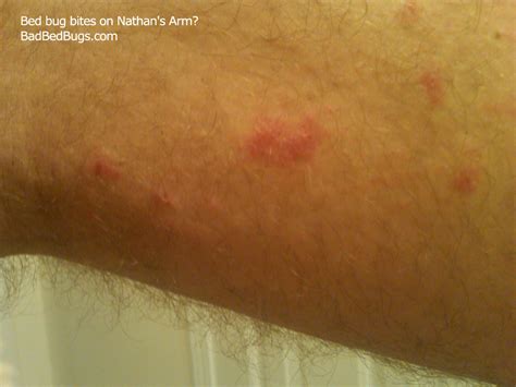 Bedbug Bites Discussion Pg 4