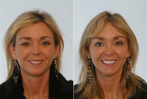 Fillers Photos | Houston, Tx | Patient 28524