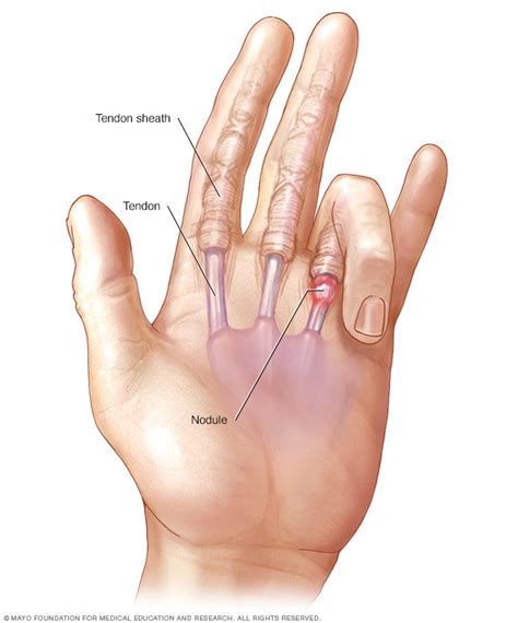 Trigger finger - Symptoms and causes - Mayo Clinic