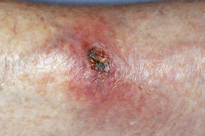 Infected laceration on the leg - Stock Image - C011/7345 - Science ...