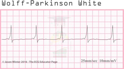 ECG Educator Blog : Atrial Rhythms