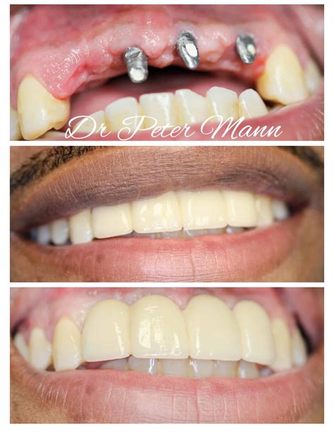 Dental Implants Before And After Photos | NYC Dentist