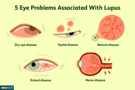 Lupus flare symptoms - lasopacareers