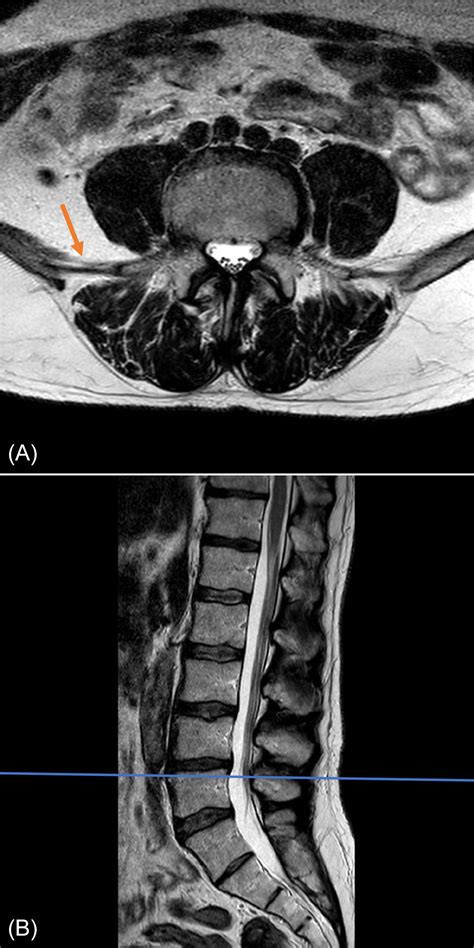 Lumbar Spine Mri Mri Scan Images Mri Mri Scan Lumbar Images | Images ...