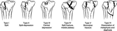 Tibial Plateau Fracture Classification