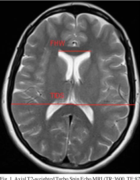 Table I from Morphometric MRI Study of the Brain Ventricles in Healthy ...