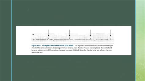 Atrio-Ventricular Dissociation - causes with ECG examples | PPT
