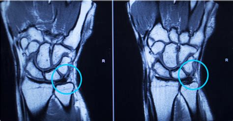 Tfcc Tear Vs Normal