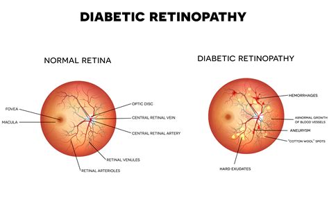 Diabetic Retinopathy – Dr. Winston J. Scott