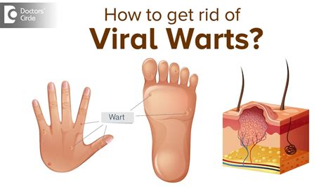 73 Images Of Viral Warts For FREE - MyWeb