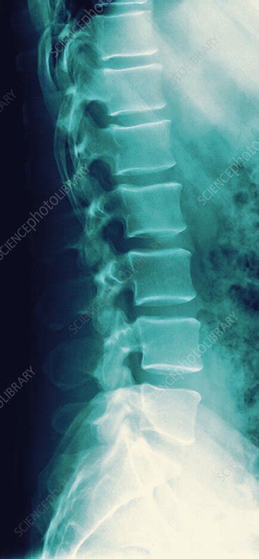 Normal spine, X-ray - Stock Image - F001/2987 - Science Photo Library