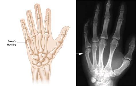 Broken Index Finger X Ray