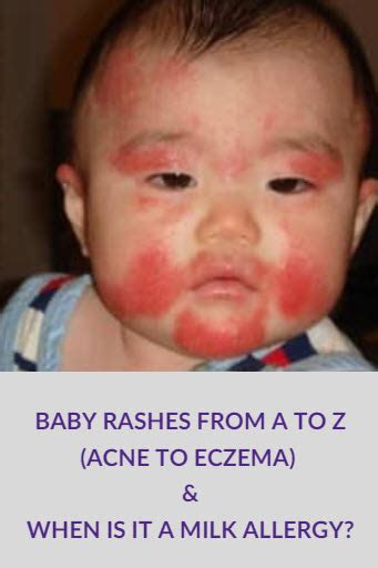 Baby Rashes from A to Z (Acne to Eczema!) and When Is It a Milk Allergy ...