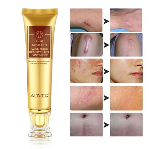 Original Acne Scar Cream Ginseng Essence Anti Acne Remover Cream Face ...