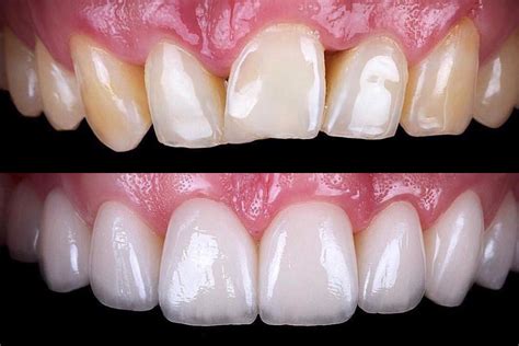 Types Of Dental Veneers Preparation - Design Talk