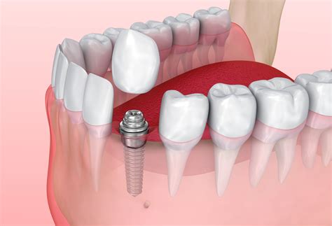 Dental Implant for Single Tooth Replacement - East Honolulu - Hawaii Kai