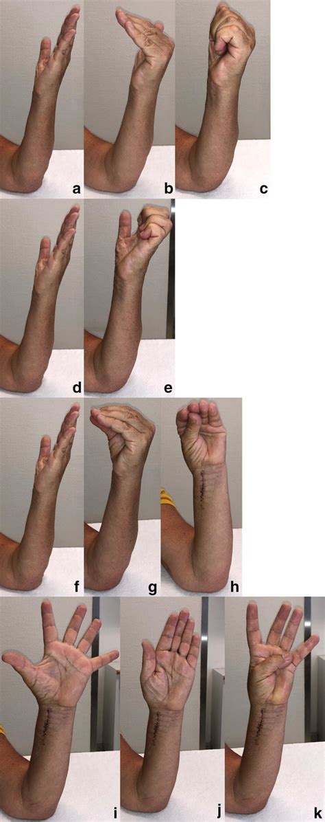 a–k Active exercises for thumb and fingers from the first day after ...