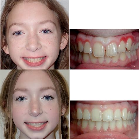 Braces Before And After Smile