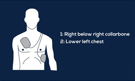 Guide to AED Pad Placement - MDPRO USA