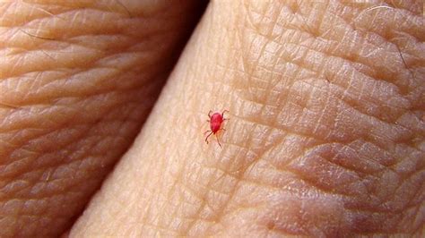 How to Know When It’s a Chigger Bite | Everyday Health