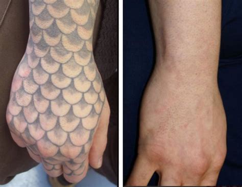 Before & After - Tattoo Removal Lexington KY | Inkundū