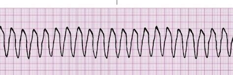 EKG strips quiz Flashcards | Quizlet