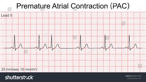 242 張 Ekg from strip 圖片、庫存照片和向量圖 | Shutterstock