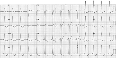 Pre-excitation syndromes • LITFL • ECG Library Diagnosis