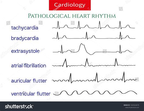 Pathological ecg collection. Shematic vector illustration of different ...