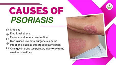 Psoriasis Unveiled: Causes, Types, Symptoms and Solutions | Care Well ...