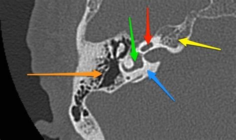 Otic capsule - blue arrow: otic capsule (dense bone) - yellow arrow ...