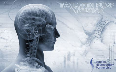 Baclofen pump - London Neurosurgery - Spine & Neurosurgery