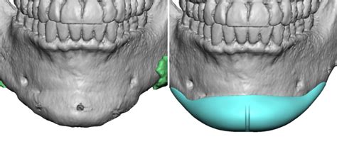 Custom Chin Implant design after Sliding Genioplasty front view Dr ...