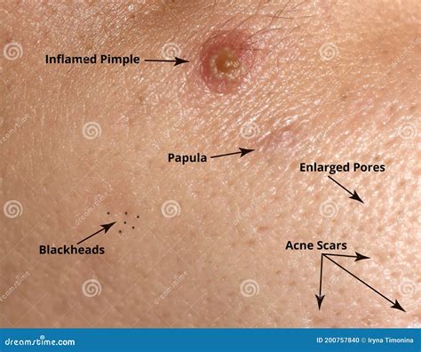 Types of Acne and Acne on the Skin. Enlarged Pores, Inflamed Pimple ...